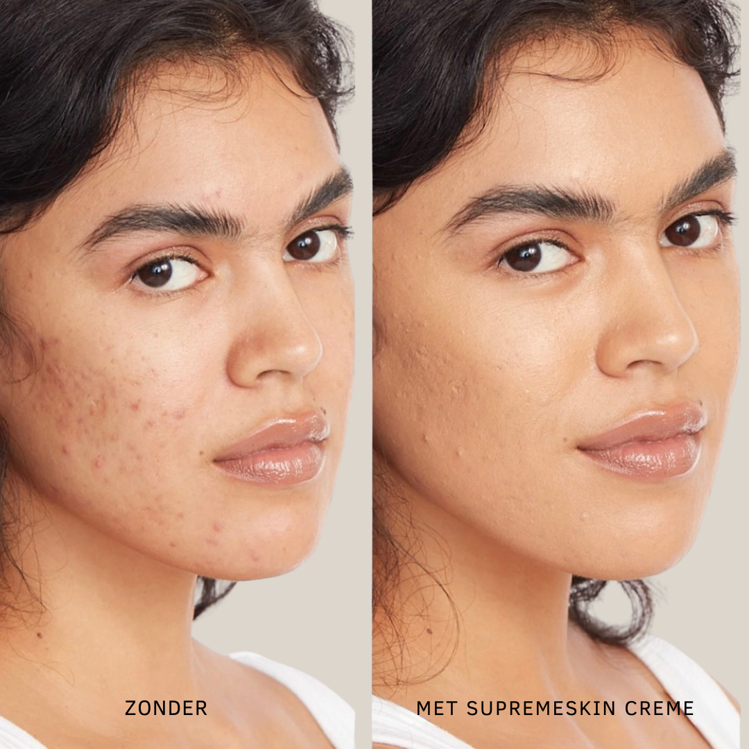 SupremeSkin – Waterdichte Concealer met Ultieme Hydratatie & Flawless Dekking