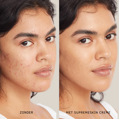 SupremeSkin – Waterdichte Concealer met Ultieme Hydratatie & Flawless Dekking